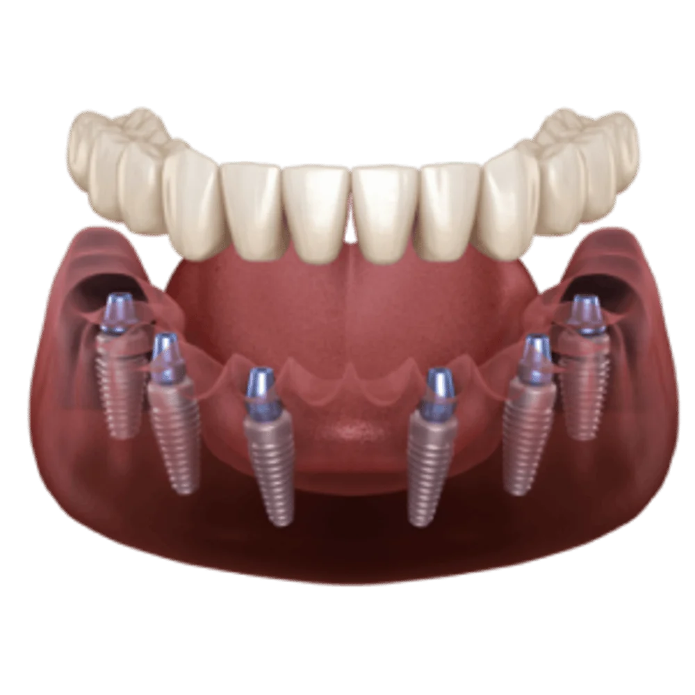 Neue feste Zähne an einem Tag